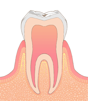 虫歯のイラストC1