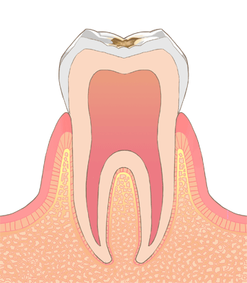 虫歯のイラストC2