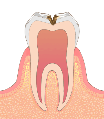 虫歯のイラストC3