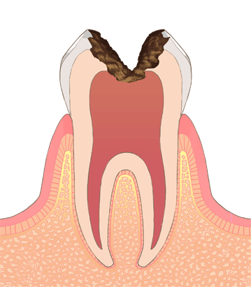 虫歯のイラストC4