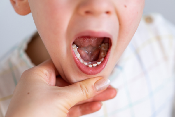 見分けが難しい「二重歯列」とは？