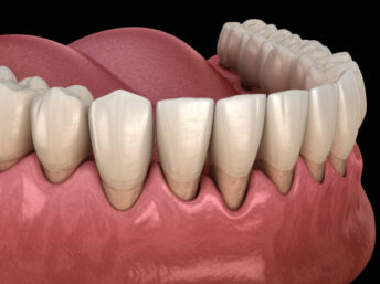 歯周病の歯ぐき