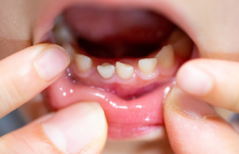 乳歯と永久歯はどう見分ける？